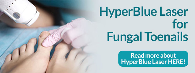 HyperBlue Laser for Fungal Toenails