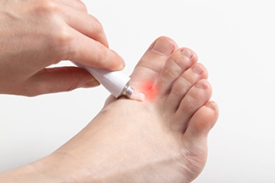 Causes, Treatments, Prevention, and Relief From Athlete’s Foot
