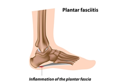 Potential Relief Options for Plantar Fasciitis